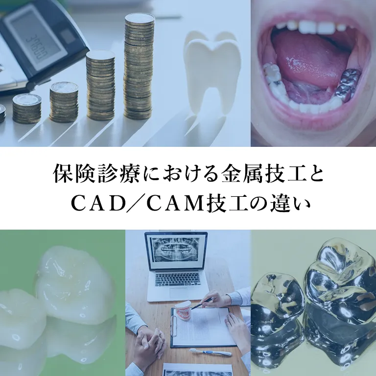 ”保険診療における金属技工とCAD/CAM技工の違い”